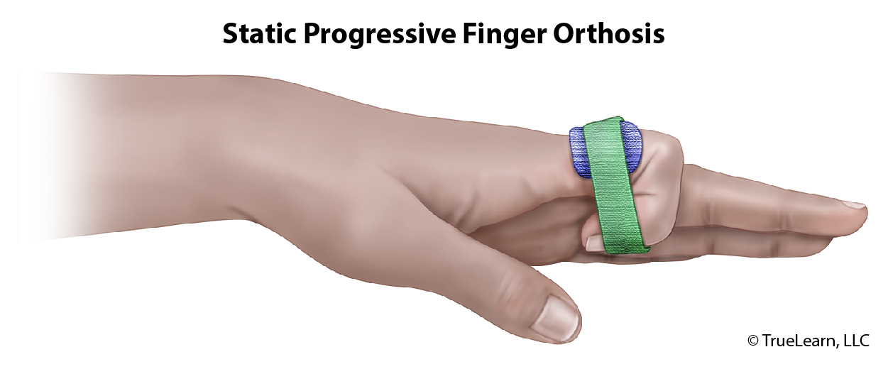 what Static Progressive Finger Orthosis looks like
